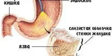 Язва желудка: симптомы, лечение, диета при обострениях