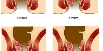 Геморрой: стадии, причины, методы лечения, профилактика