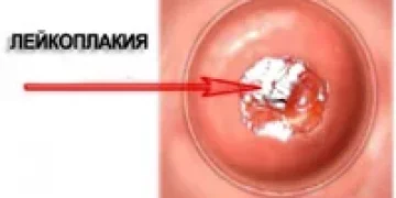 Лейкоплакия шейки матки: лечение, симптомы, причины, диагностика и последствия заболевания