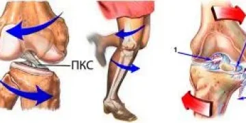 Разрыв медиального мениска коленного сустава