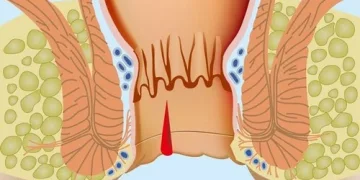 Боль в заднем проходе